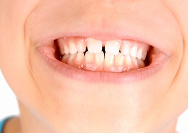 permuta-denti-latte_2-674x640